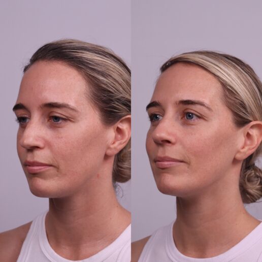 Photographs of a woman's face before and after cosmetic treatment