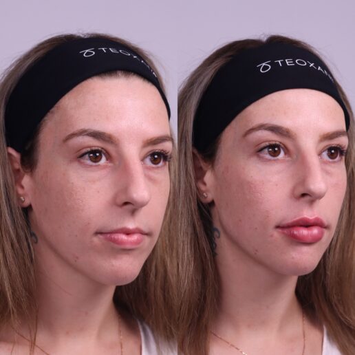 Photographs of a woman's face before and after cosmetic treatment