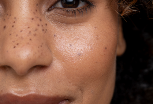 Close up photograph of a females face with freckles on her nose and cheeks