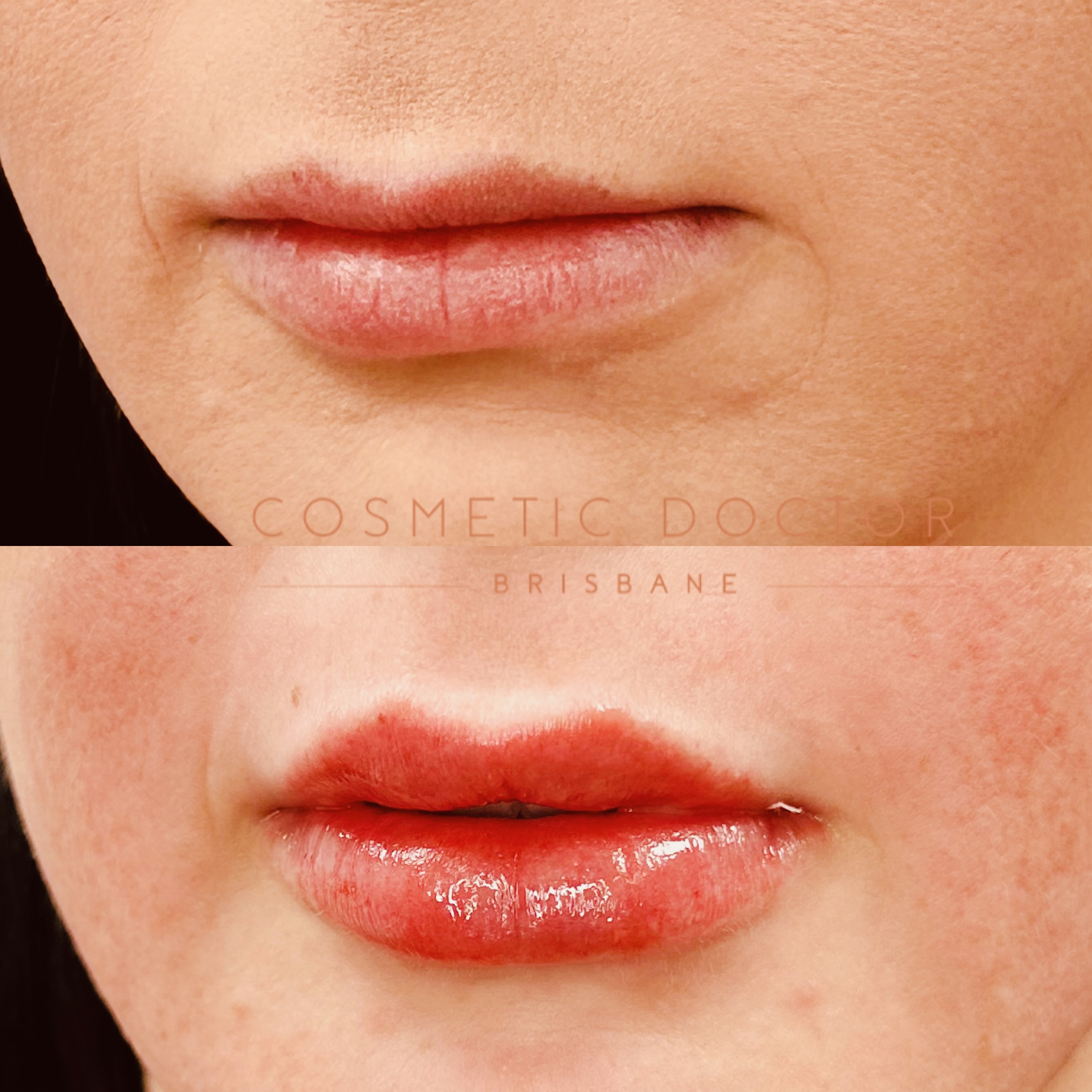 Before and after of dermal lip filler performed by Dr Tarek Shalabi at cosmetic doctor brisbane