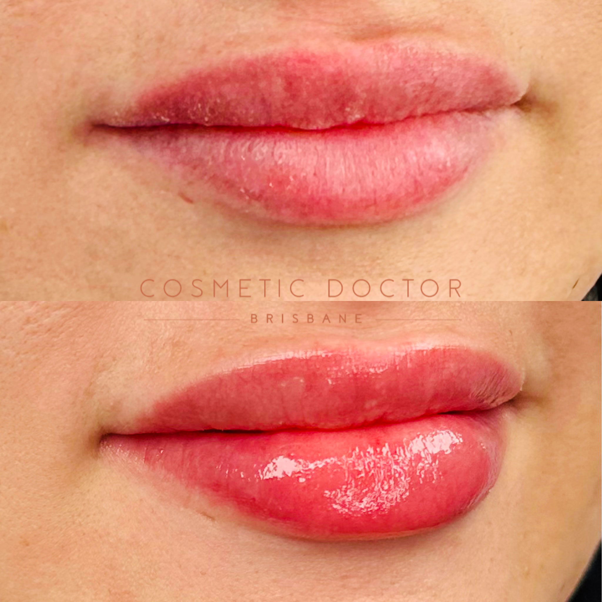 Before and after of dermal lip filler performed by Dr Tarek Shalabi at cosmetic doctor brisbane