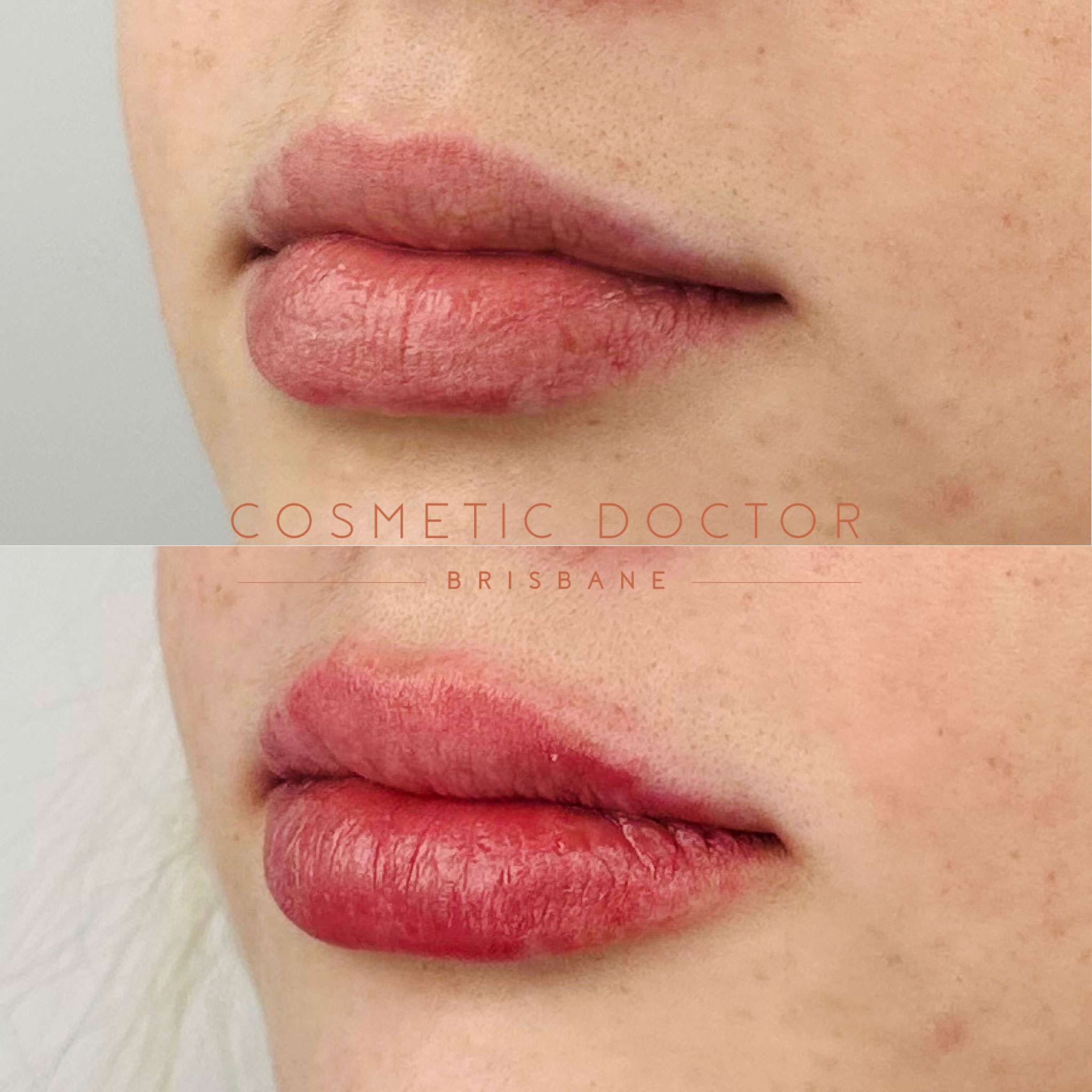 Before and after of dermal lip filler performed by Dr Tarek Shalabi at cosmetic doctor brisbane