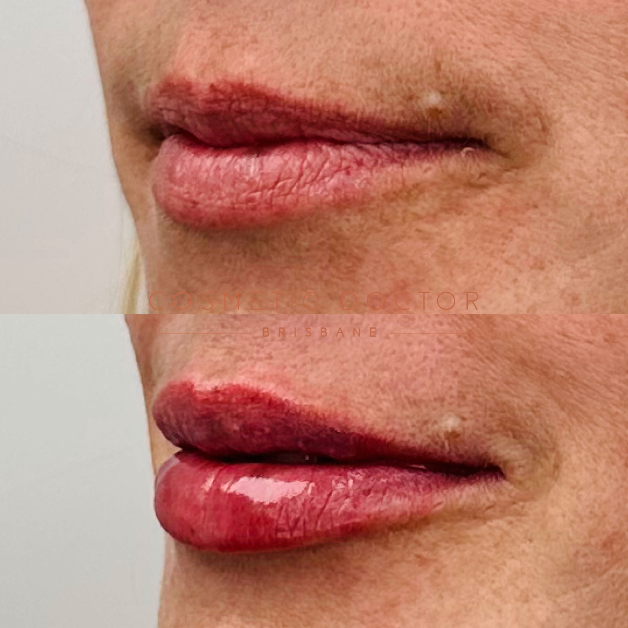 Before and after of dermal lip filler performed by Dr Tarek Shalabi at cosmetic doctor brisbane
