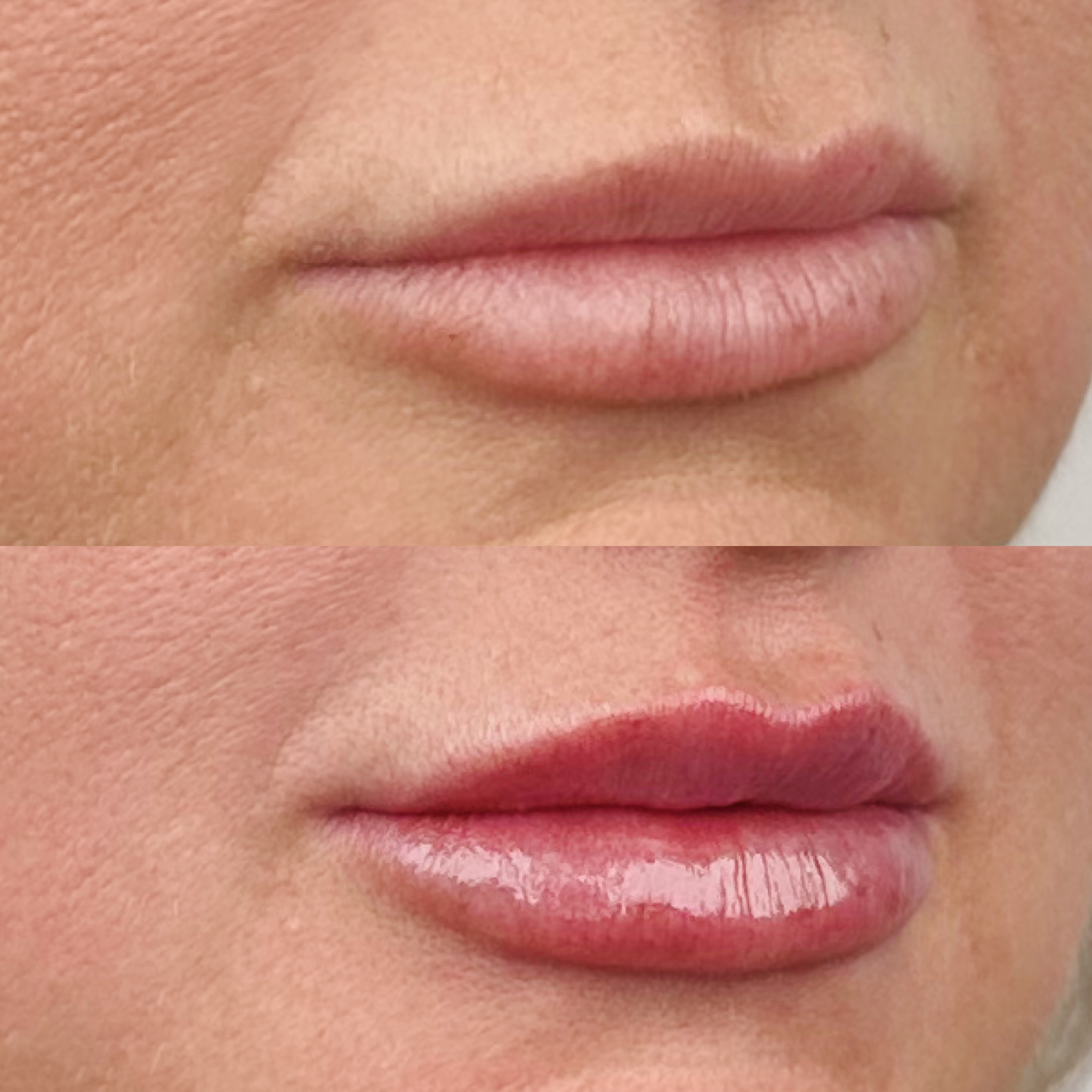 Before and after of dermal lip filler performed by Dr Tarek Shalabi at cosmetic doctor brisbane