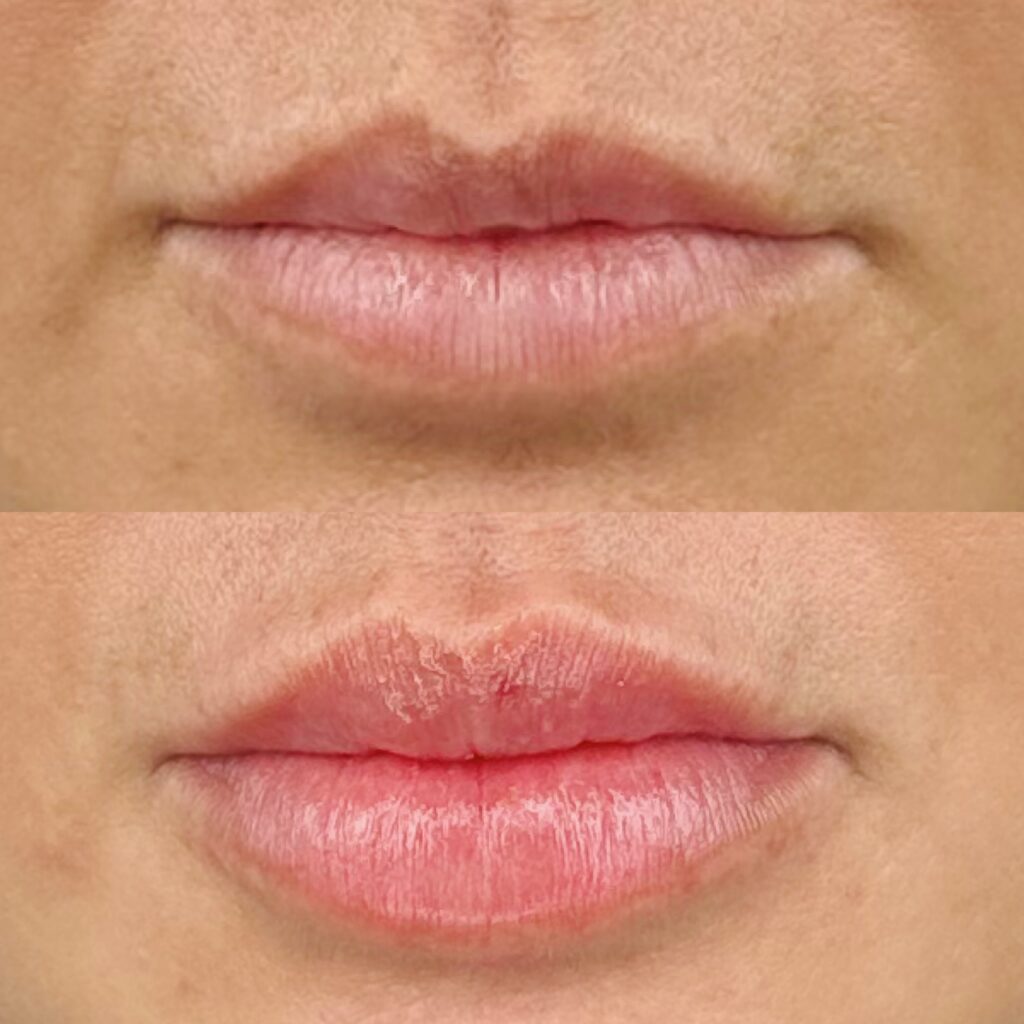 Lip Filler Brisbane Cosmetic Doctor Brisbane
