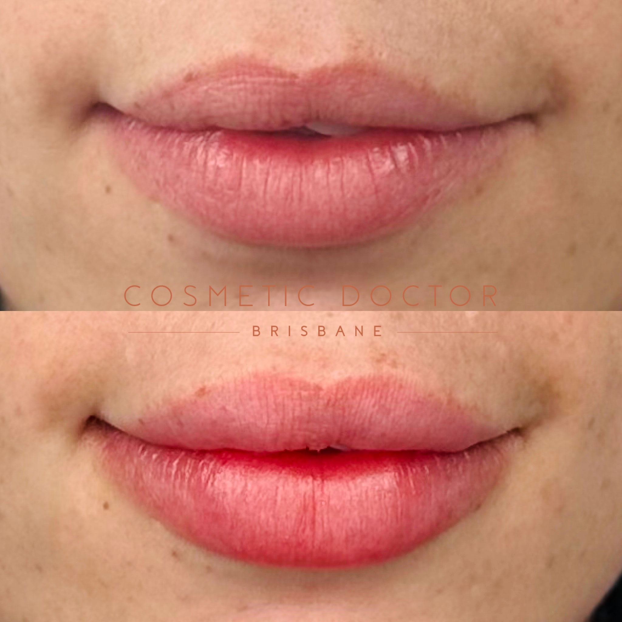 Before and after of dermal lip filler performed by Dr Tarek Shalabi at cosmetic doctor brisbane