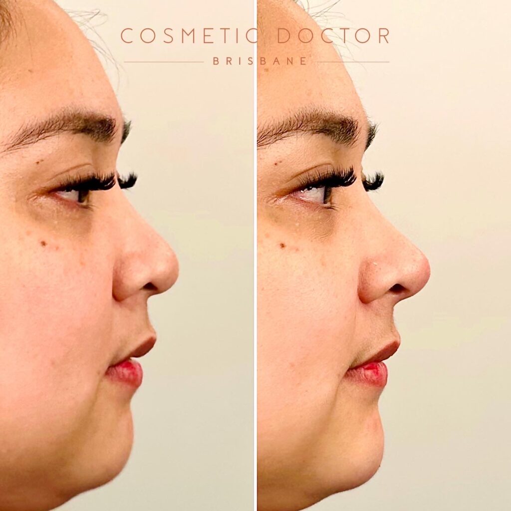 Nonsurgical Nose Filler Brisbane Cosmetic Doctor Brisbane