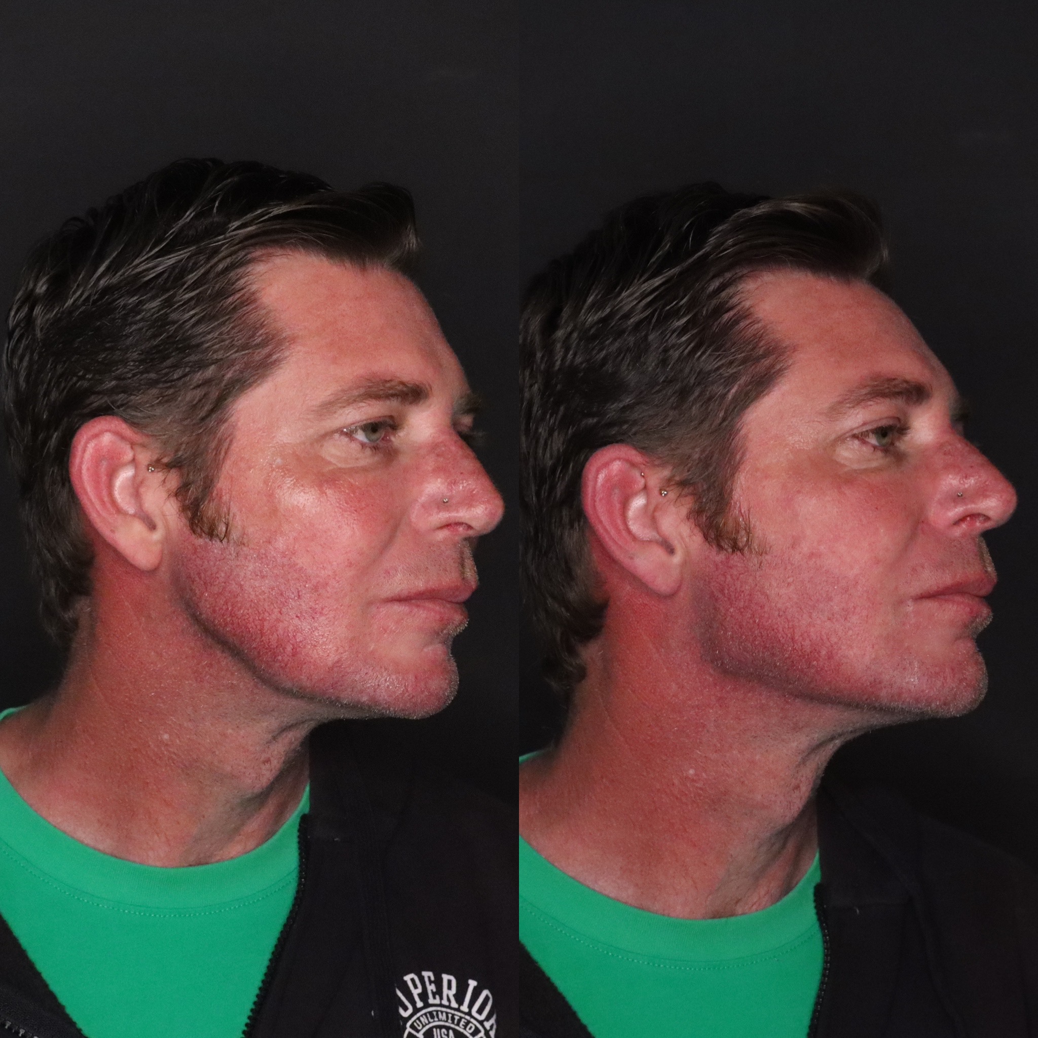 Photographs of a man's face before and after cosmetic treatment