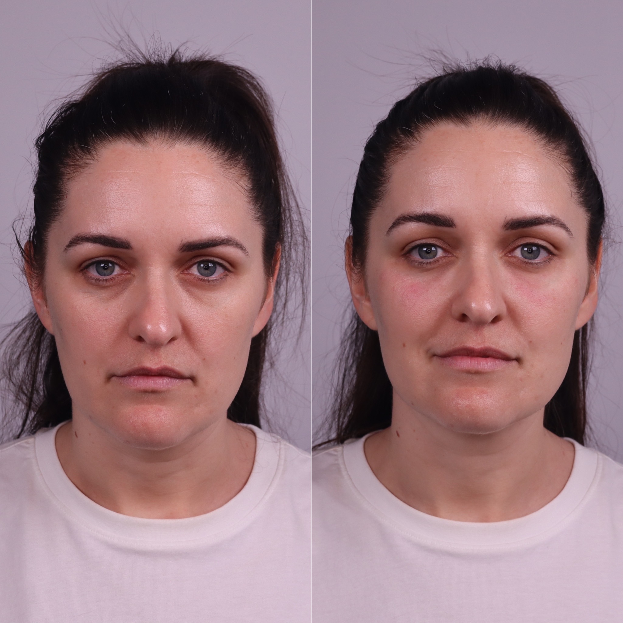 Eye Filler Cosmetic Doctor Brisbane