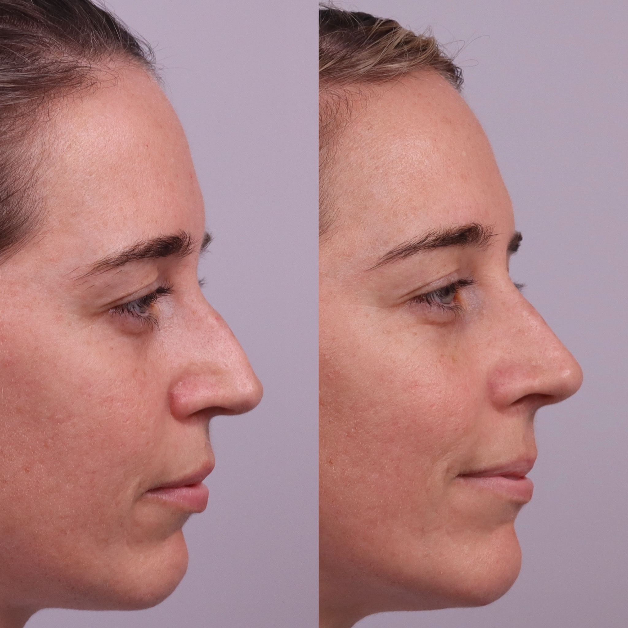 Before and after nose filler photographs