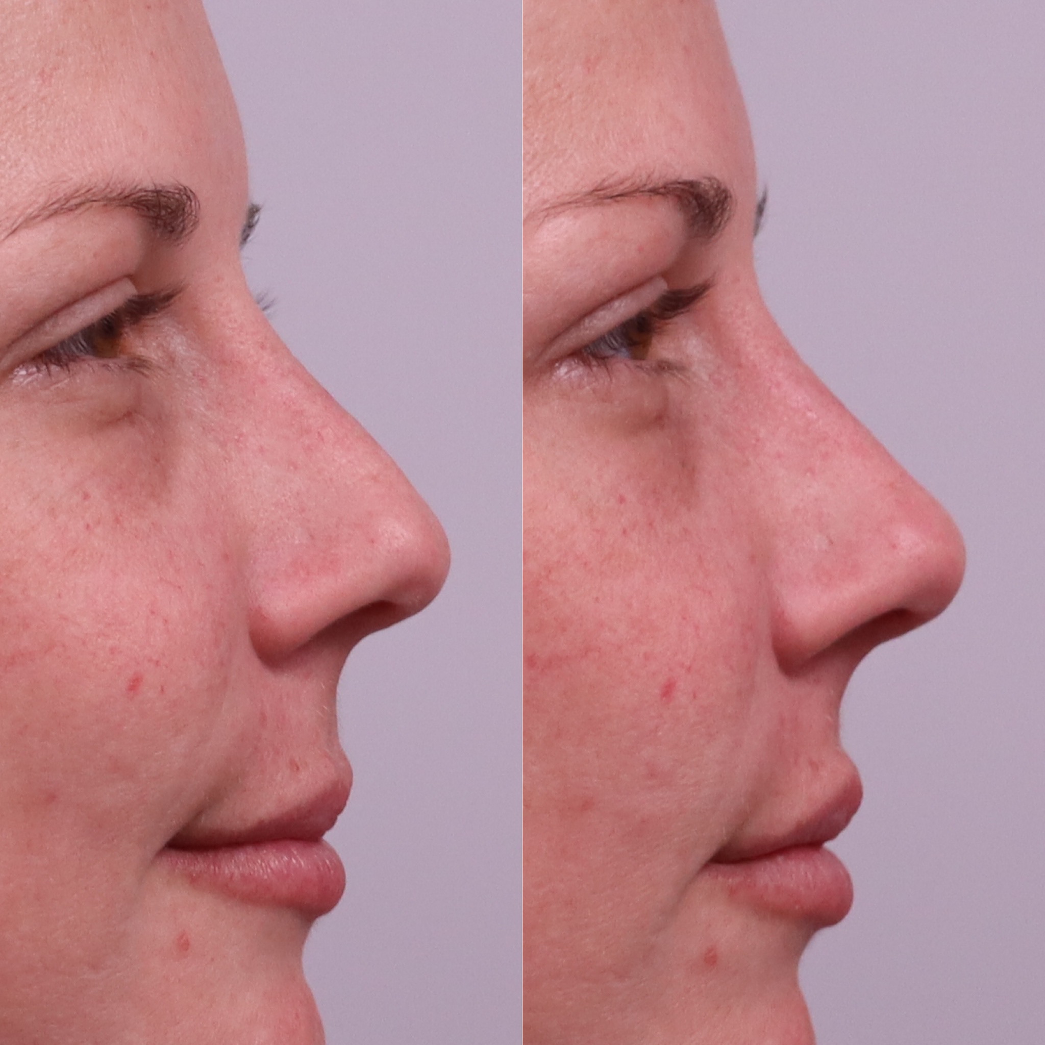 Before and after nose filler photographs