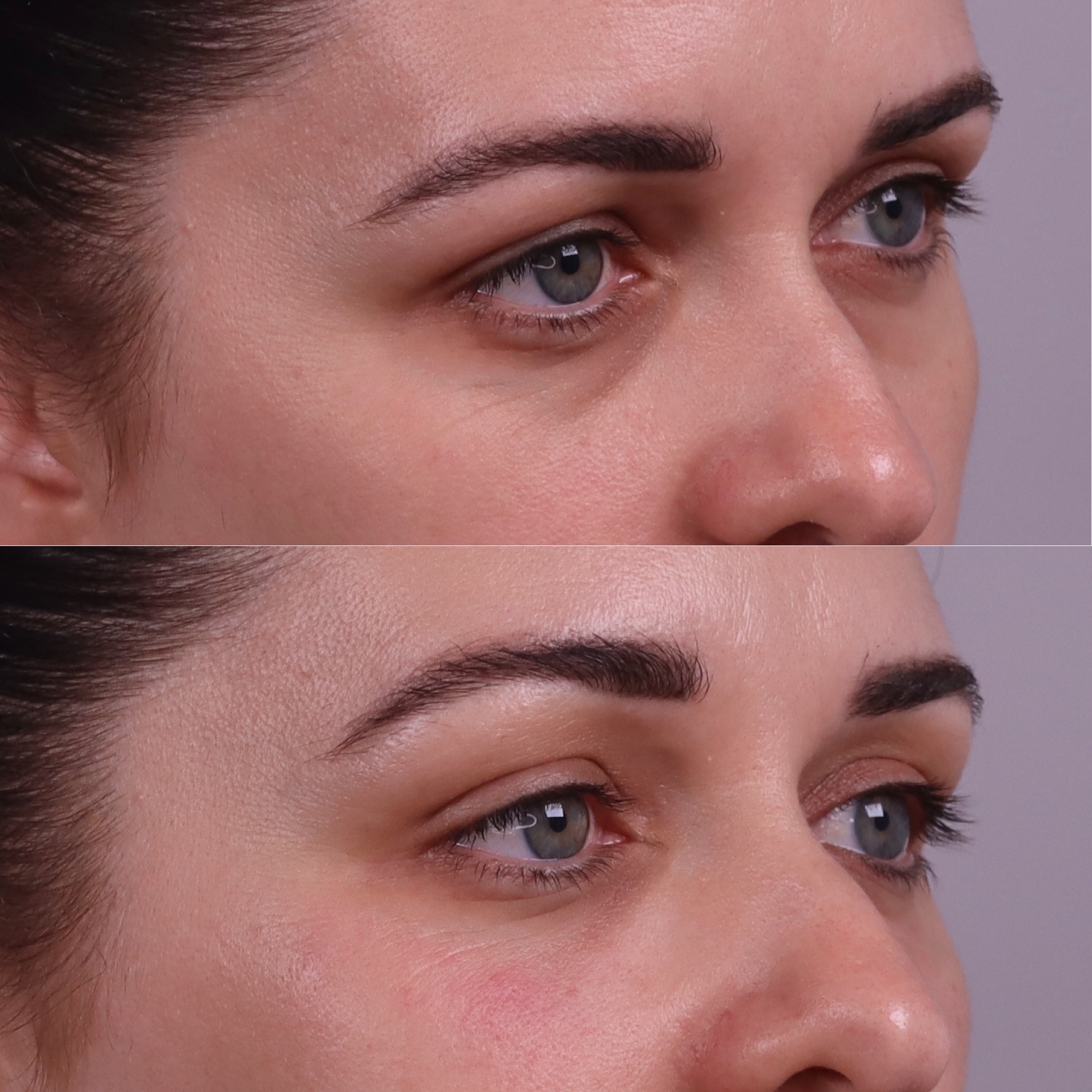 Before and after under eye filler photographs