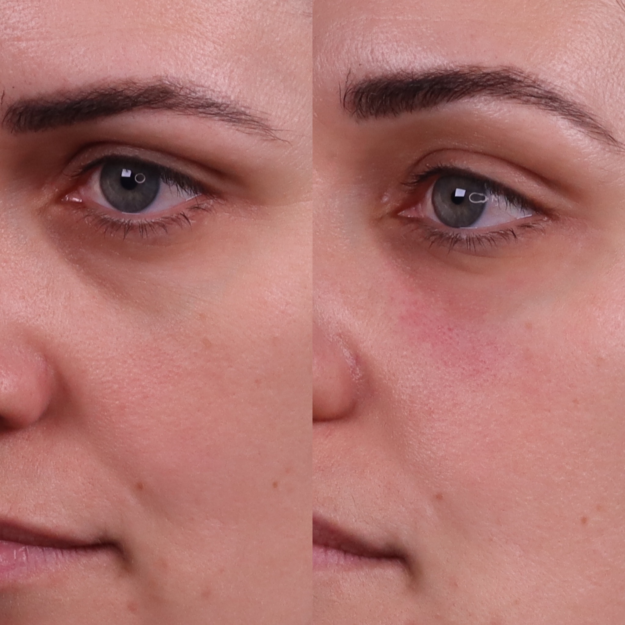 Eye Filler Cosmetic Doctor Brisbane