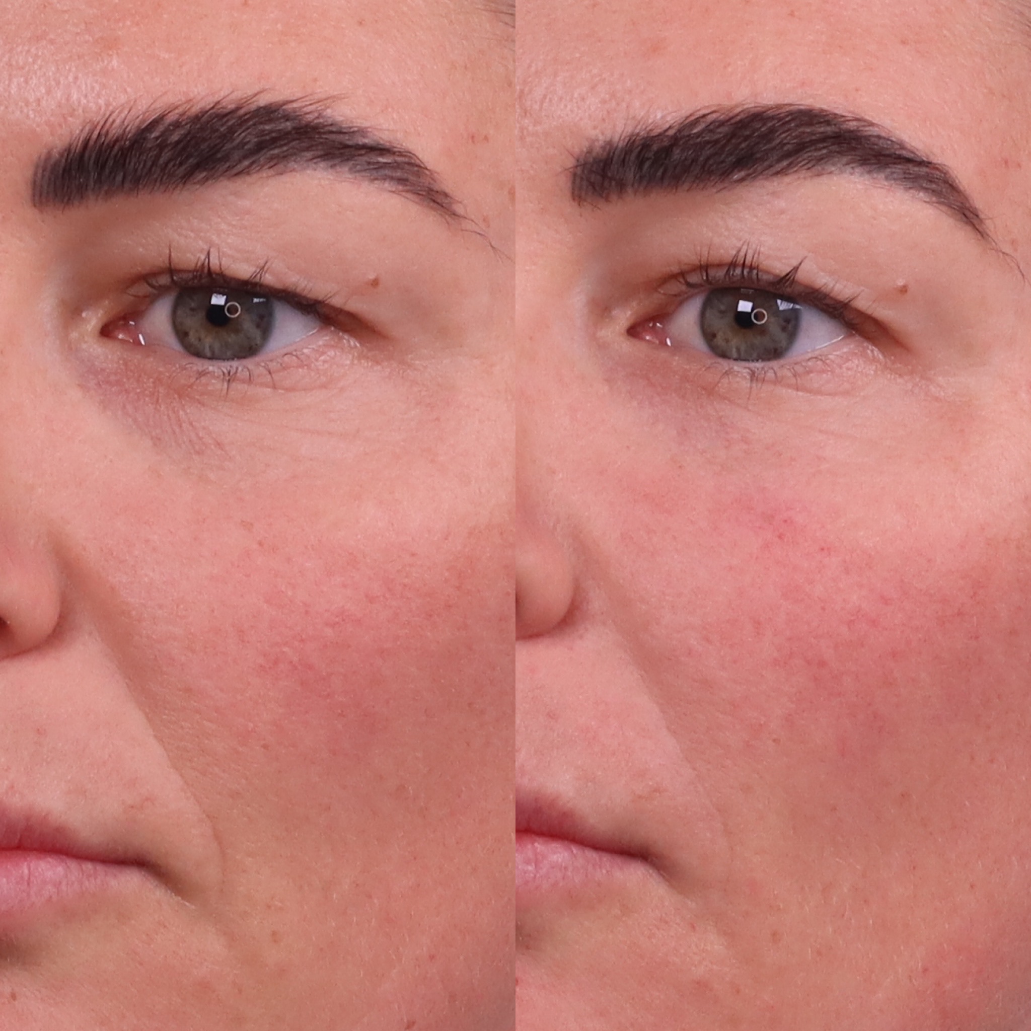 before and after under eye filler photographs