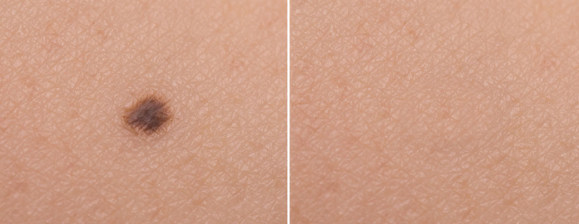 before and after of cosmetic mole removal by cosmetic doctor brisbane