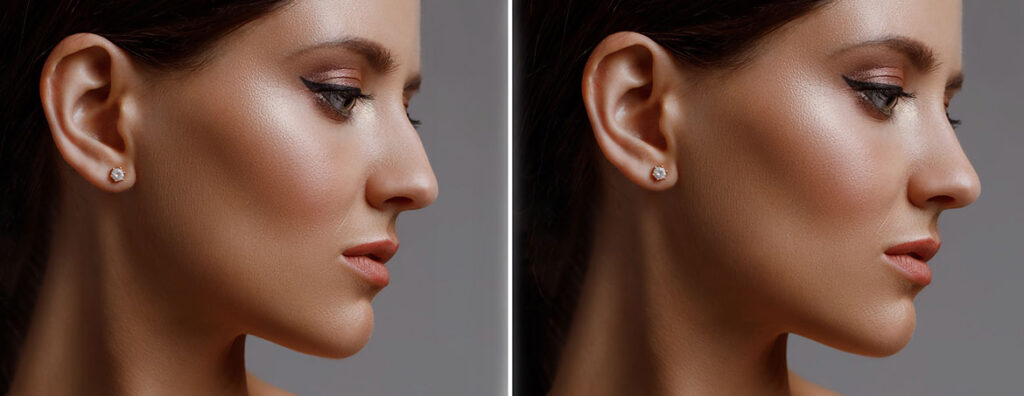 Non-surgical nose filler displayed in a before and after on a female model