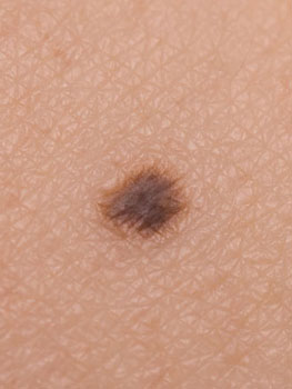 Close up of small mole for cosmetic mole removal